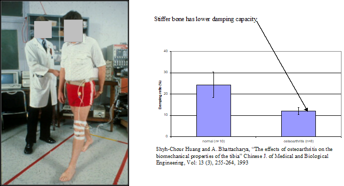 A person standing with osteoarthritis measuring equipment. Also a bar chart comparing a normal bone, and a bone with osteoarthritis. The graph shows the bone with osteoarthritis measures a lower damping capacity