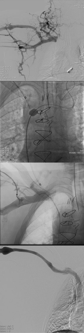 central-chest-vein