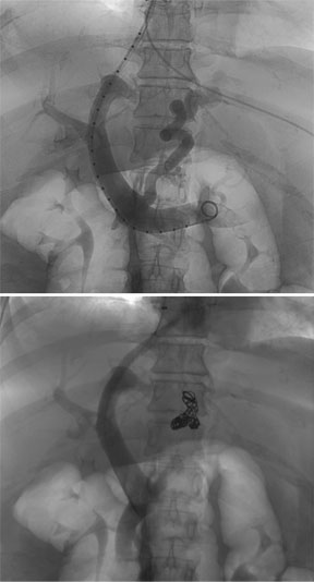 gastric-variceal-embolization